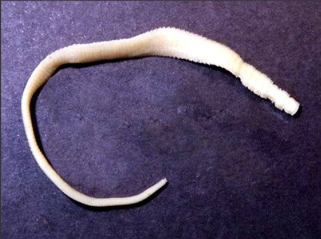 Diphyllobothriasis
