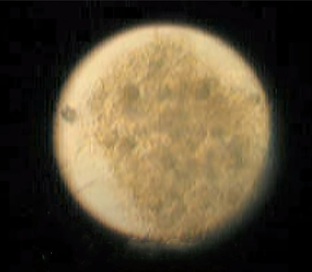 Cyst